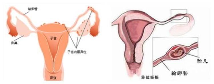 验孕棒一条杠